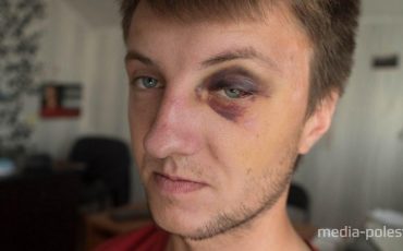 В таком виде вышел из Пинского ИВС видеокорреспондент «Медиа-Полесья» Евгений Николаевич